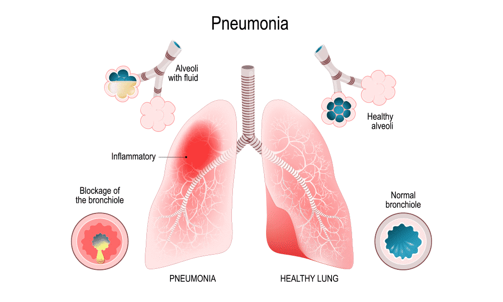 Pneumonia illustration