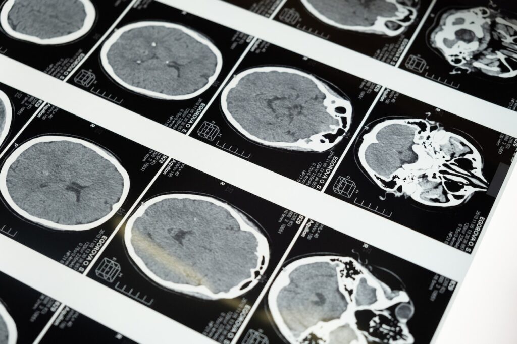 showing multiple mri brain scan